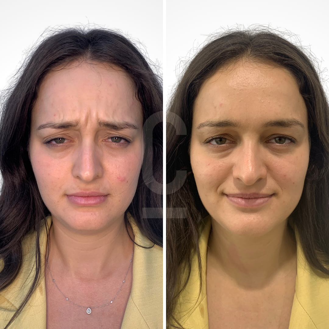 Side-by-side images of a woman. The left image shows her with a frown, while the right image shows her smiling slightly. She has long brown hair and is wearing a yellow jacket. The background is plain white.