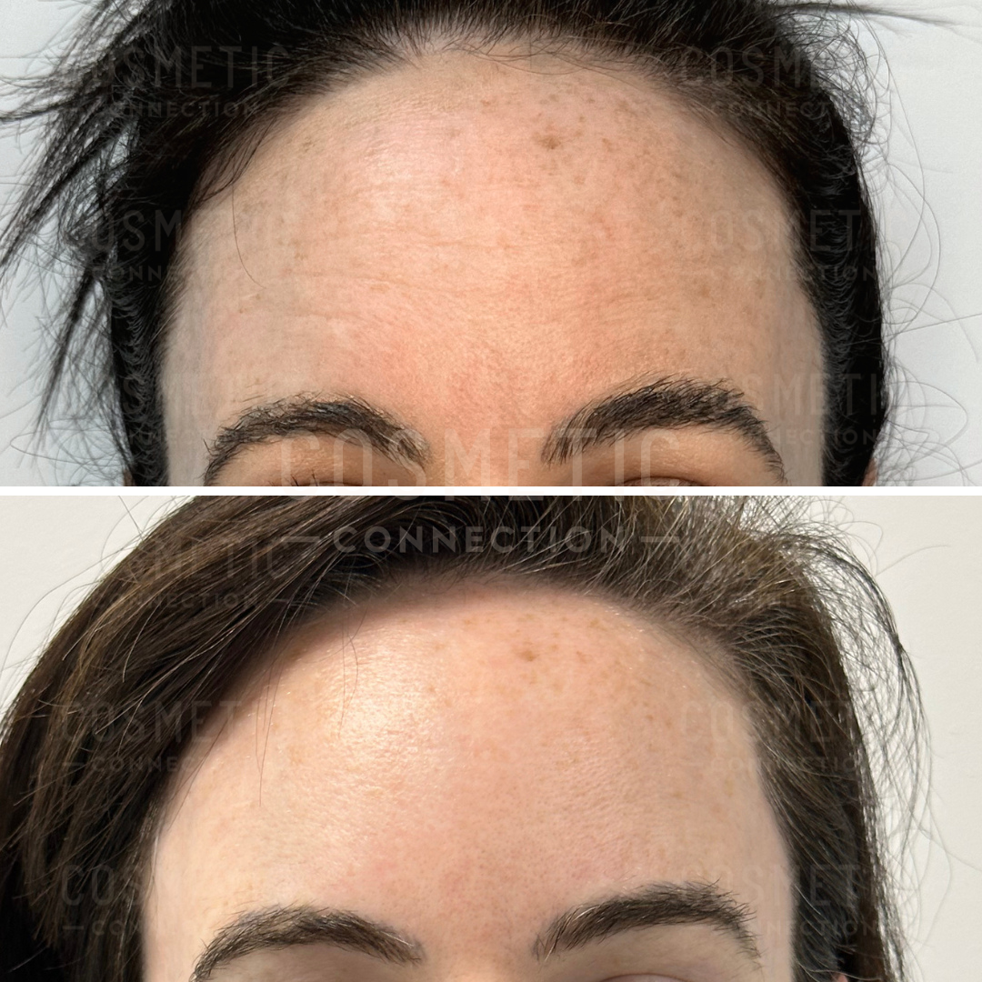 Close-up comparison of two foreheads. Top image shows skin with visible freckles and uneven texture. Bottom image shows smoother skin with reduced freckles and even complexion.