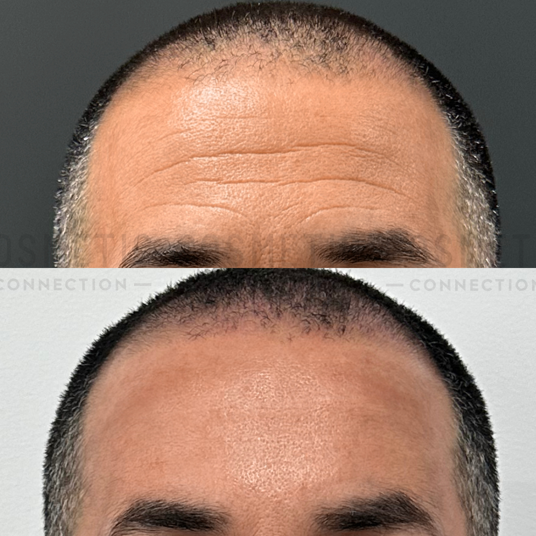 Close-up of a mans head before and after hair treatment. The top image shows thinning hair and a receding hairline, while the bottom image displays a fuller head of hair with improved coverage.