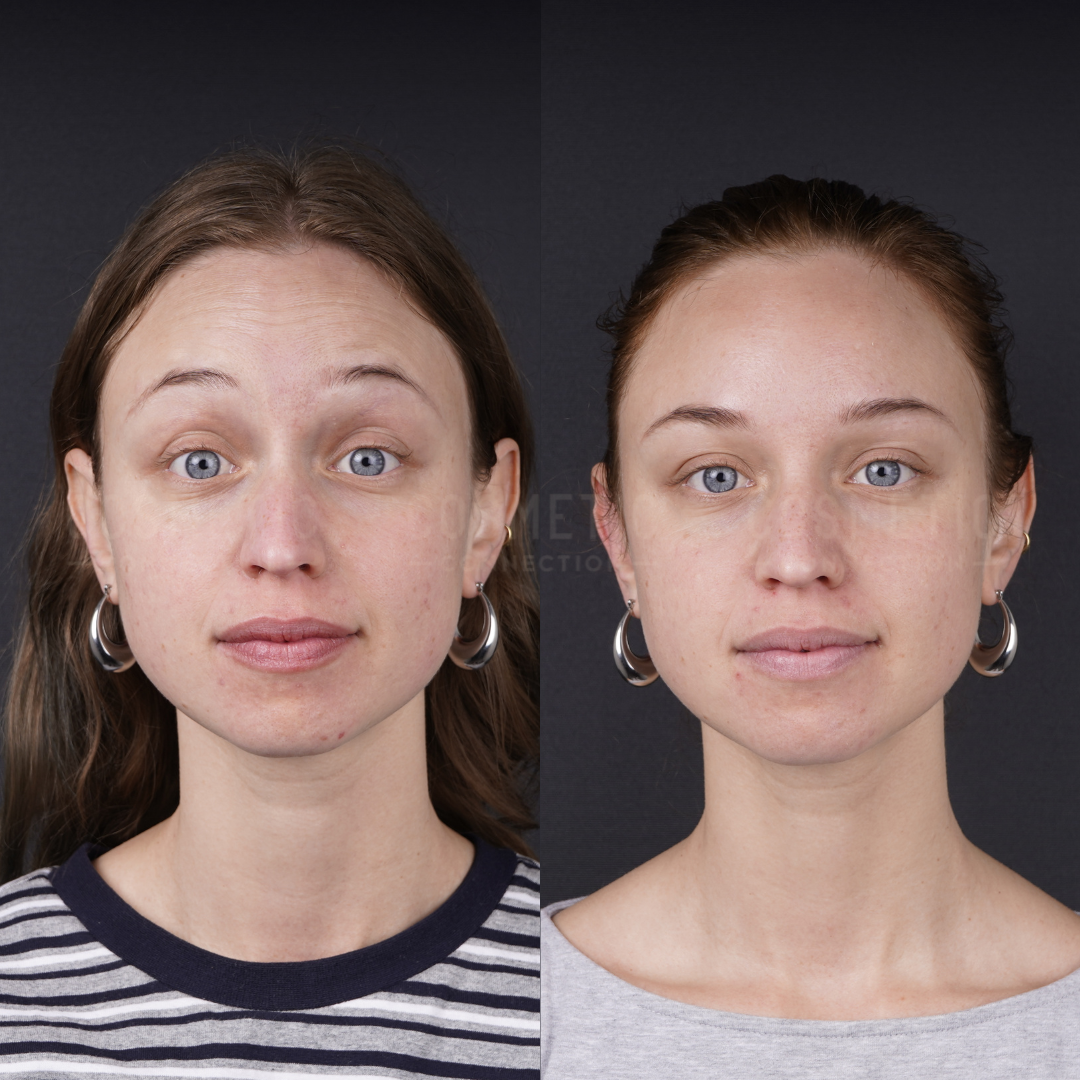 Two side-by-side portraits of a woman with blue eyes and hoop earrings, showing a before and after comparison. The left image shows uneven skin tone; the right image shows clearer skin and a smoother complexion.