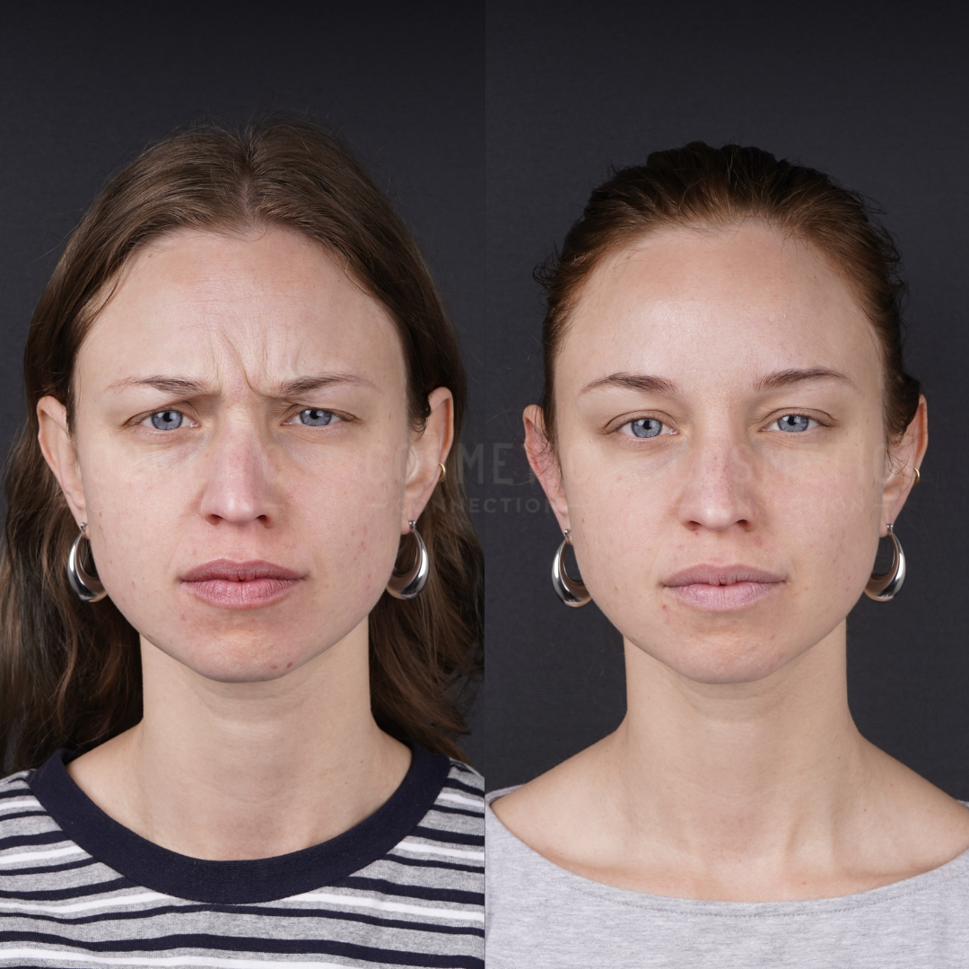 Side-by-side photos of a woman with light skin and hoop earrings; left image shows her frowning with furrowed brows, right image shows a neutral expression with smoother forehead lines.