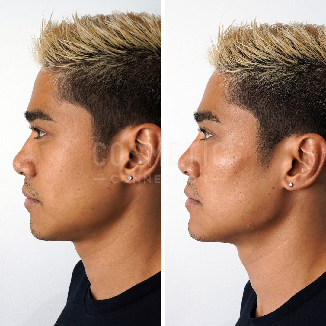 Side-by-side profile images of a person showing a before-and-after transformation. The left image shows a fuller chin, while the right image shows a more defined jawline. The person has short, blond-tipped hair and is wearing a black shirt and earrings.