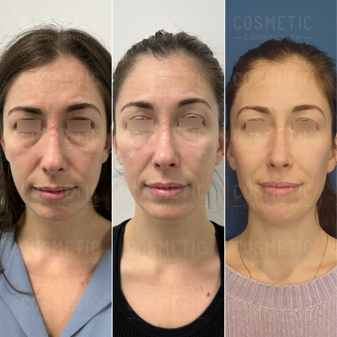 A woman is shown in three side-by-side photos, displaying her face before and after a medical procedure. The images highlight changes in her facial features over time.
