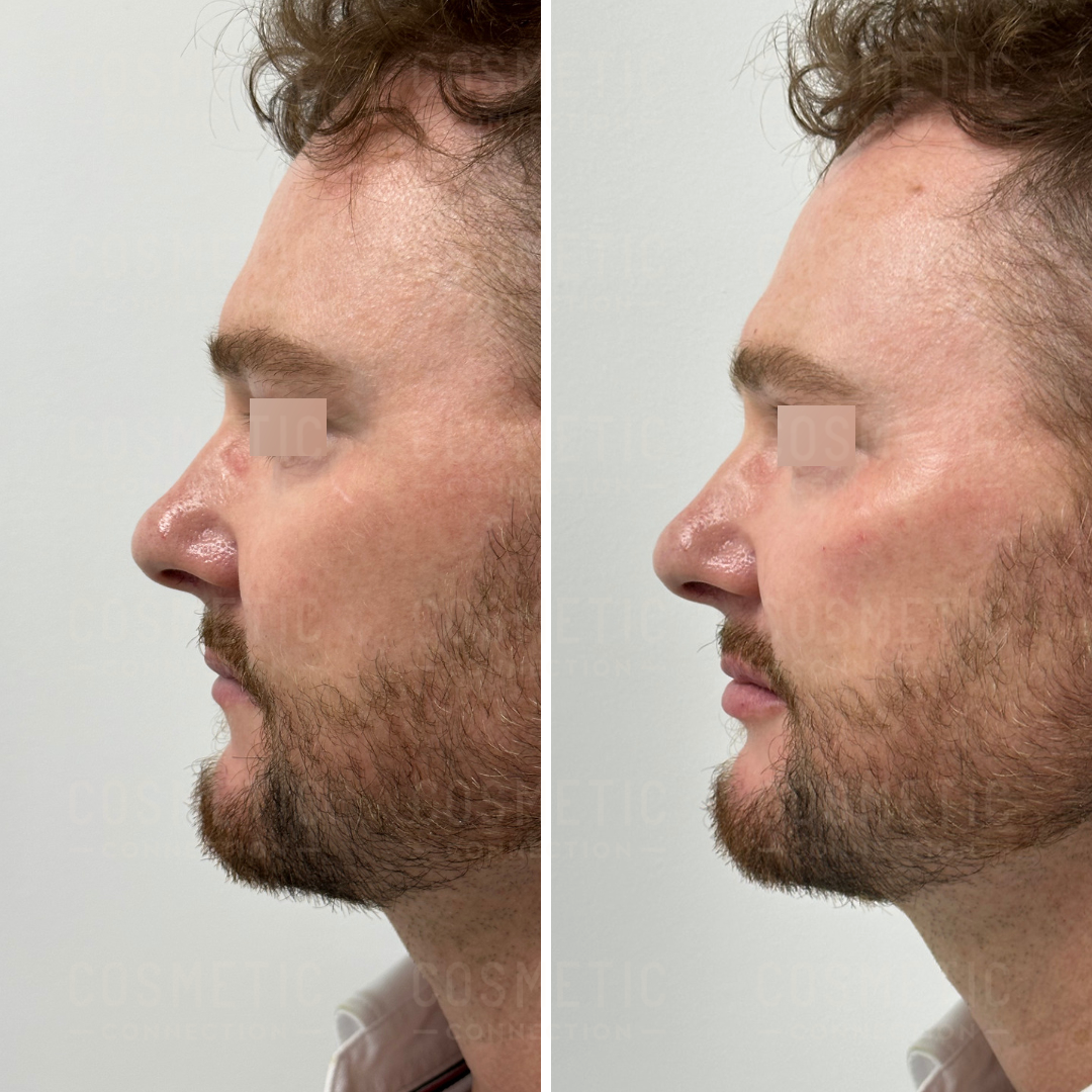 Side-by-side comparison of a mans profile before and after rhinoplasty. The left image shows the original nose shape, and the right image highlights changes with a straighter nose bridge and refined nasal tip. The man has a beard and short curly hair.