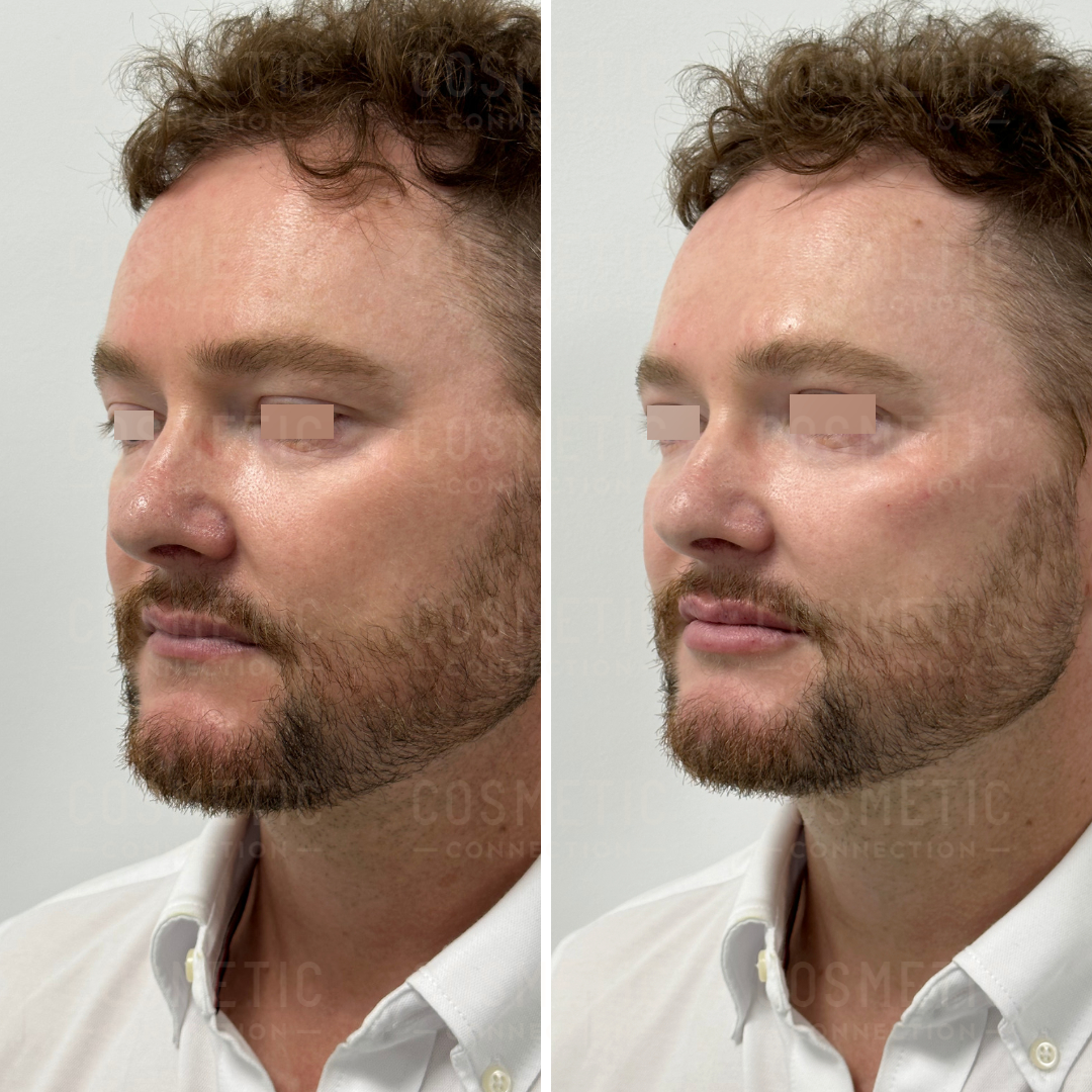Side-by-side images of a person with eyes obscured, showing before and after views of cosmetic treatment. The person has short curly hair and a trimmed beard, wearing a white shirt, with subtle changes visible in facial contours.