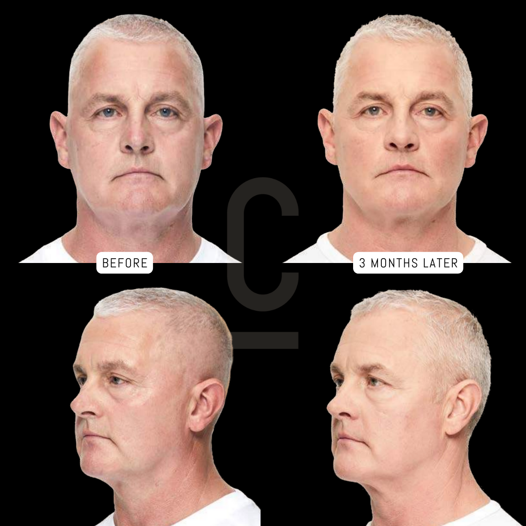A comparison of a man before and after three months. The two images show his face from the front and side, highlighting changes over time. Both images have labels: Before and 3 Months Later.