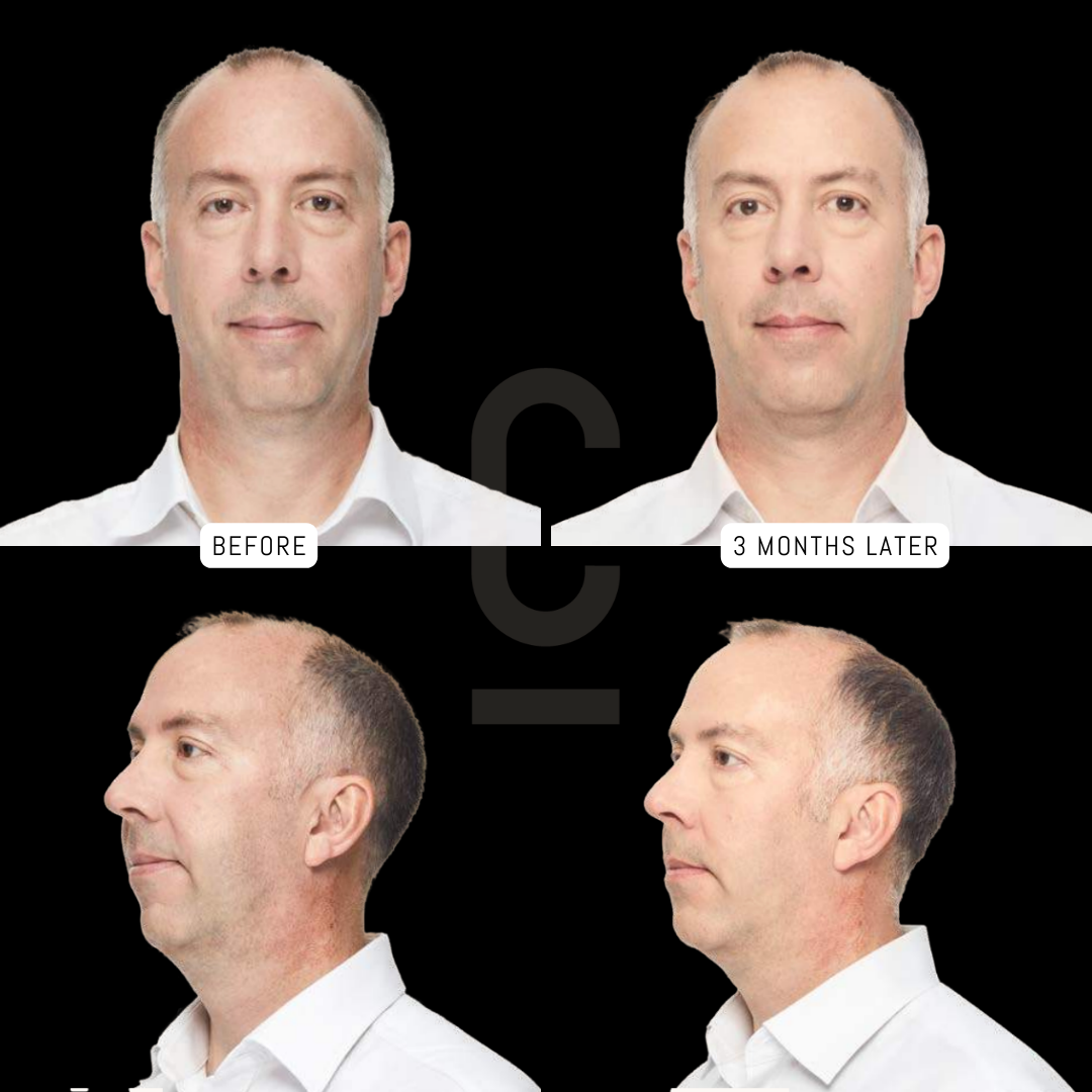 Two sets of before and after photos show a man from the front and side view, both labeled Before and 3 months later. The man, in a white shirt, displays noticeable changes over the period.