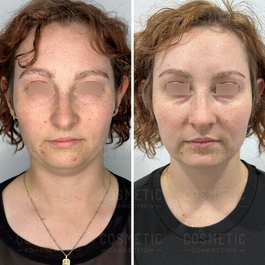 Side-by-side images of a person with short curly hair before and after a cosmetic procedure. The left image shows freckles and acne, while the right shows smoother skin. Both images have eyes obscured for privacy.