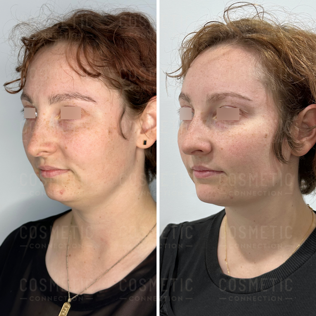 Side-by-side comparison of a persons face before and after a cosmetic procedure. The left image shows lightweight freckles and subtle skin texture, while the right image displays smoother skin and a more defined jawline. The eyes are intentionally obscured.