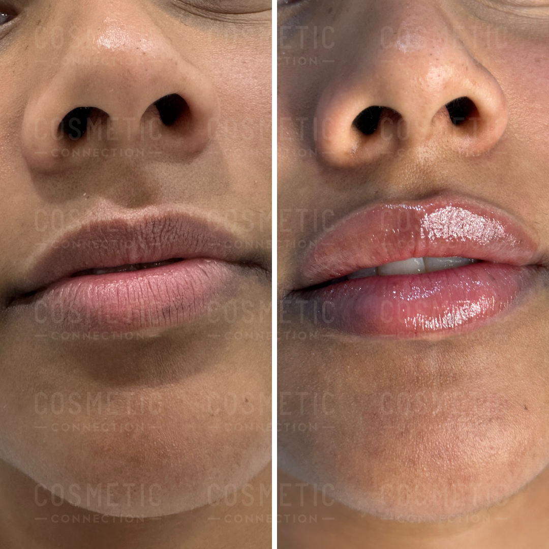 Close-up of a persons lips showing a before-and-after transformation. The left side shows natural lips, while the right side shows fuller, glossy lips with a slight shine, suggesting enhancement. The background is neutral.