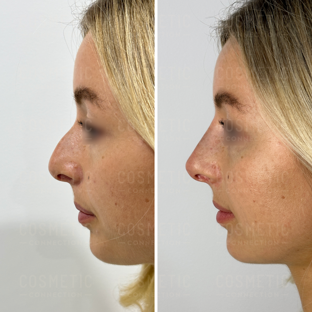 Side-by-side profile views of a persons face before and after a cosmetic procedure. The left image shows the original nose shape, and the right image shows a refined nose with a smoother contour. Both images feature the same person with blonde hair.