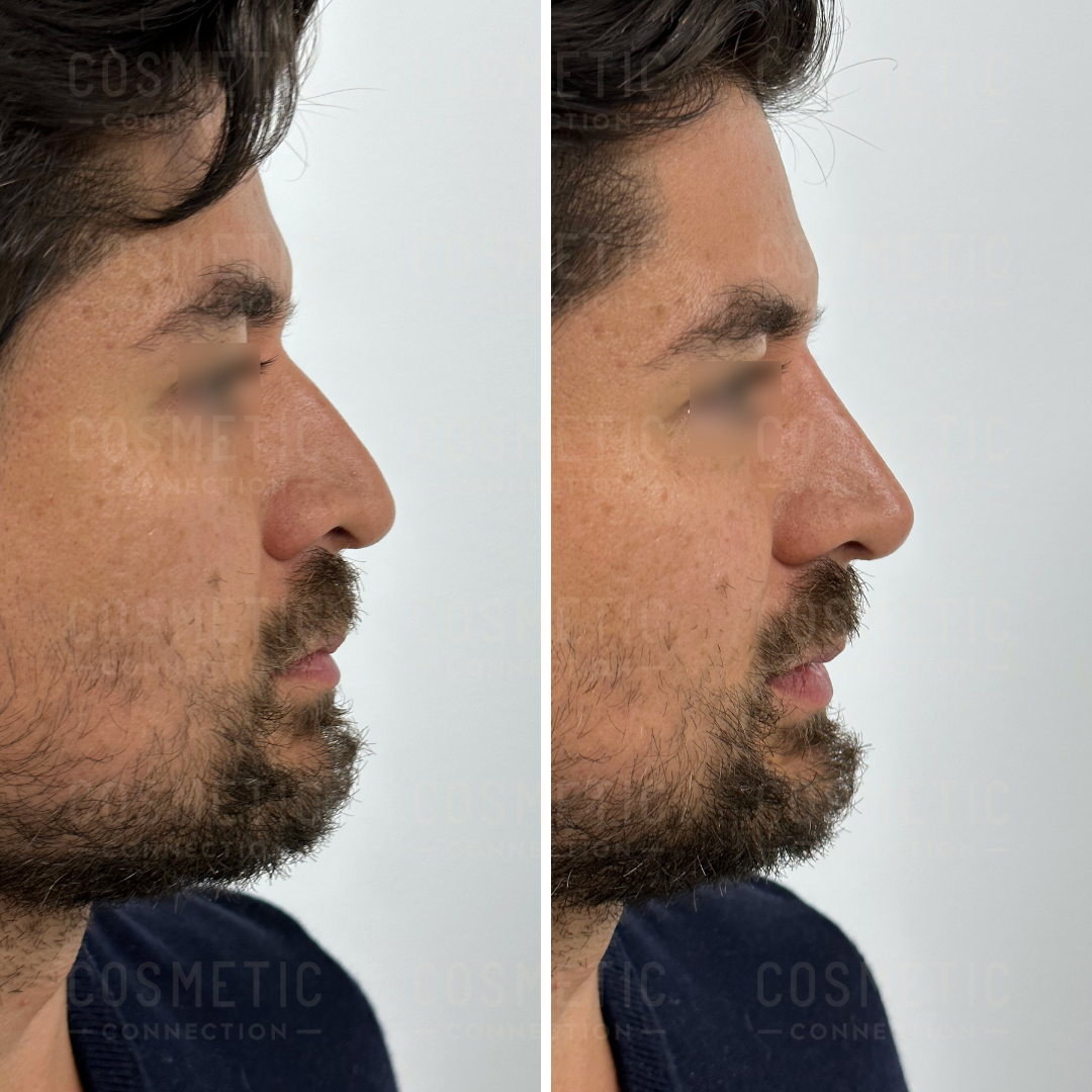 Side-by-side comparison of a mans profile before and after a cosmetic procedure, showing changes in the shape of his nose and jawline. The image features a bearded man with dark hair and a blurred background.