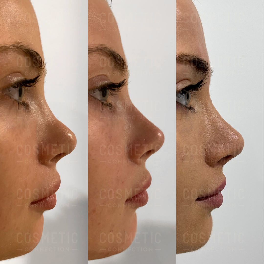 Three side-profile images of the same person showing different stages of a cosmetic procedure on the nose. The photos depict changes in the noses shape and structure from the left to the right image.