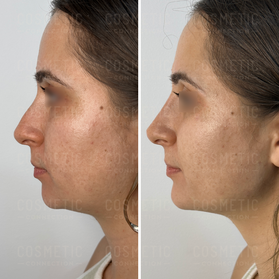 Side-by-side profile comparison of a womans face before and after a cosmetic procedure. The left image shows a more prominent nose, while the right image shows a smoother nose profile. The womans hair is pulled back in both images.