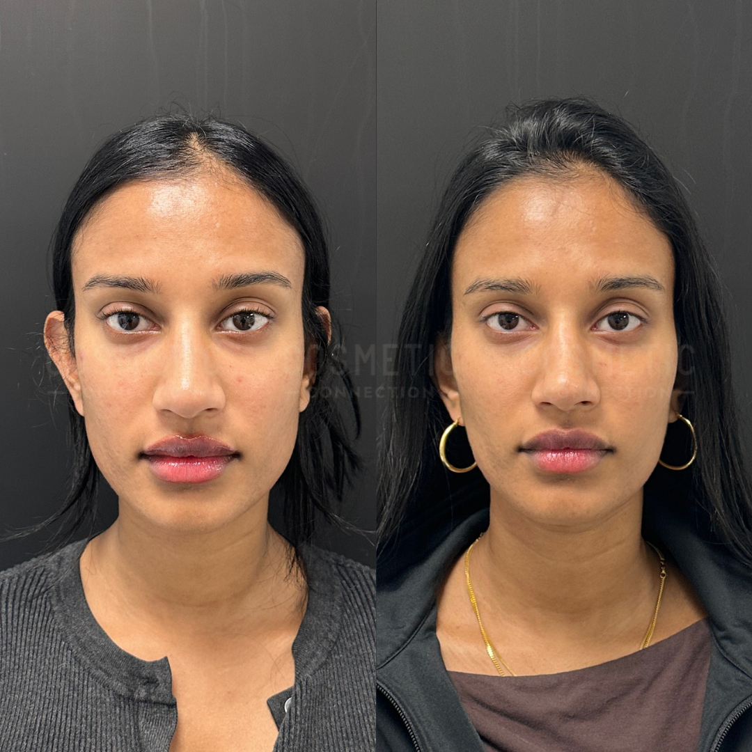 Side-by-side photos of a woman facing forward. Left: she has more prominent ears, loose hair, and wears a gray top. Right: her ears appear less prominent, and she wears a black jacket, gold necklace, and hoop earrings.