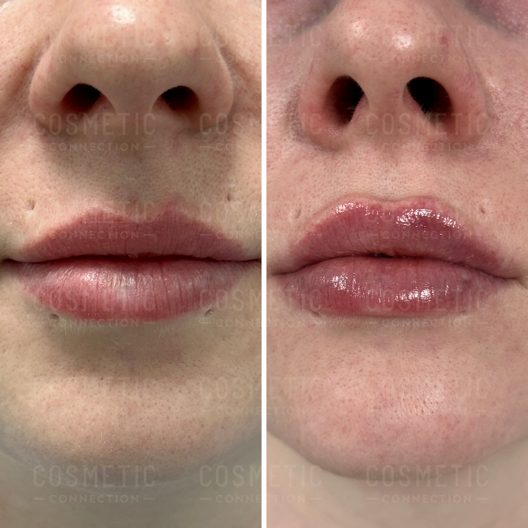 Close-up comparison of lips before and after cosmetic treatment. The left side shows natural lips, and the right side shows enhanced, fuller lips with a glossy appearance.