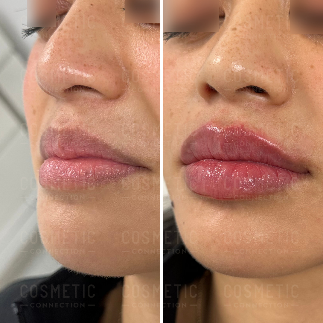 Side-by-side comparison of lips before and after enhancement. The left image shows the lips with a natural appearance, while the right image shows fuller, plumper lips.