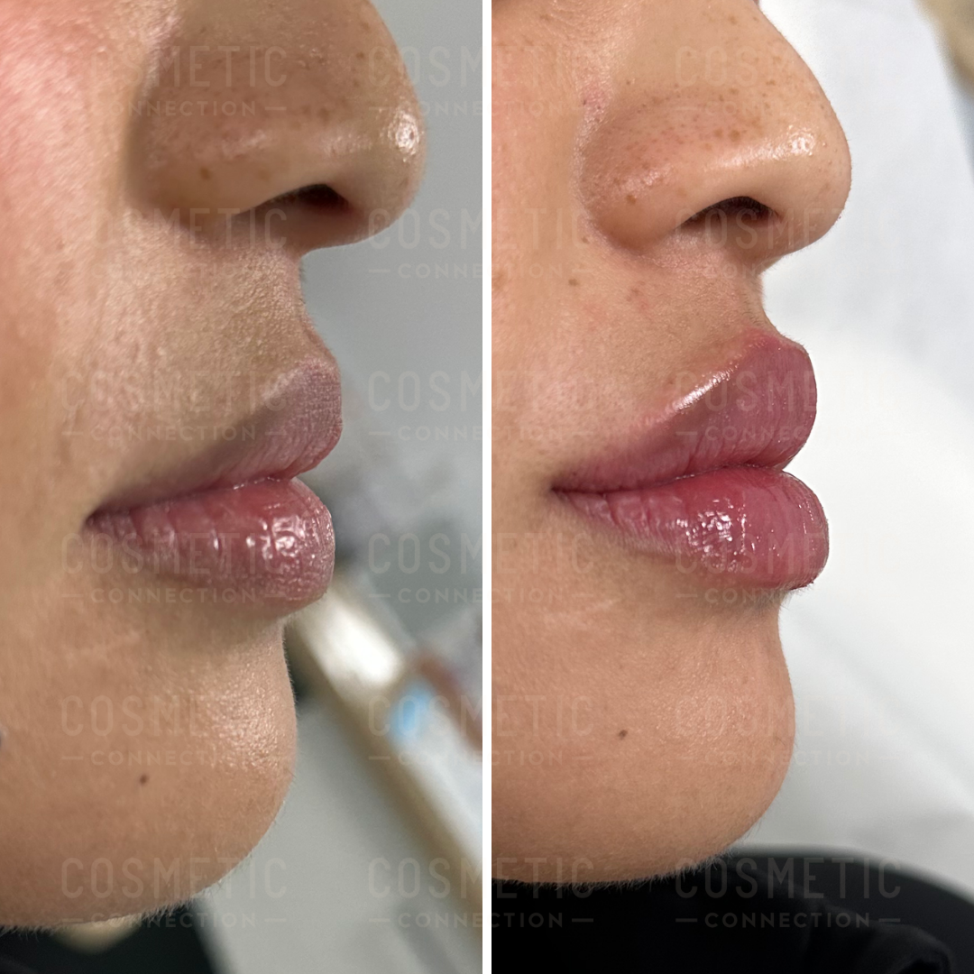 Side-by-side comparison of a persons lips before and after a cosmetic procedure. The left image shows less volume, while the right image shows fuller, more defined lips. Both have a glossy finish.