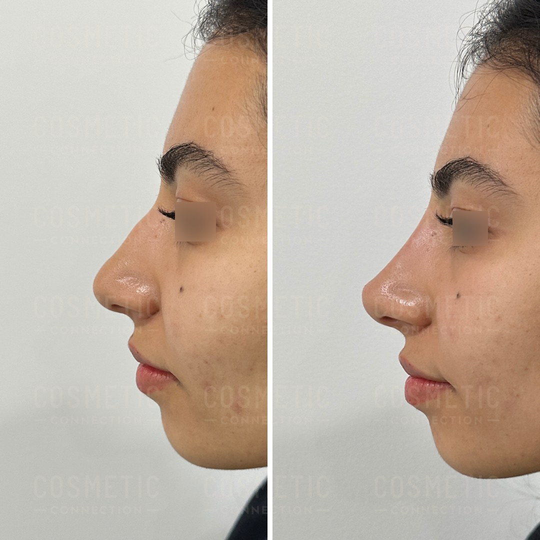 Side-by-side comparison of a persons profile before and after a cosmetic procedure on the nose. The left image shows a more pronounced nose, while the right image shows a smoother, slightly smaller nasal profile.