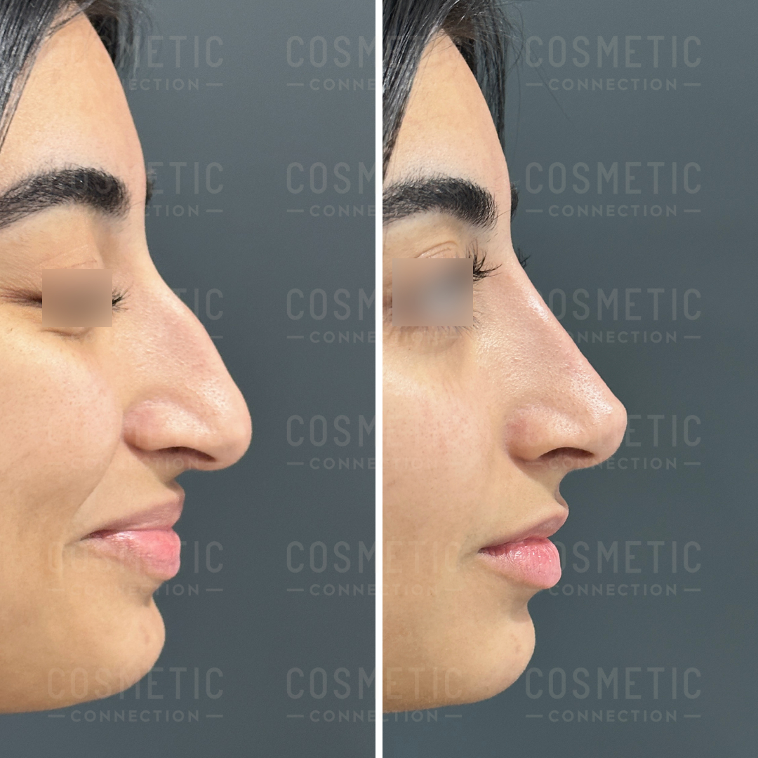 Side-by-side comparison of a womans profile before and after rhinoplasty. The left image shows a prominent nose with a dorsal hump, while the right image shows a smoother, straightened nose. Background is a neutral gray.