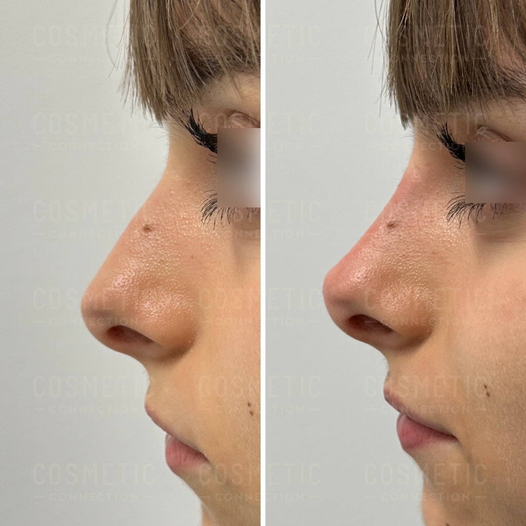 Side-by-side comparison of a persons nose before and after cosmetic surgery. The left image shows a nose with a more pronounced bridge, while the right image shows a smoother profile. The eyes are partially blurred.