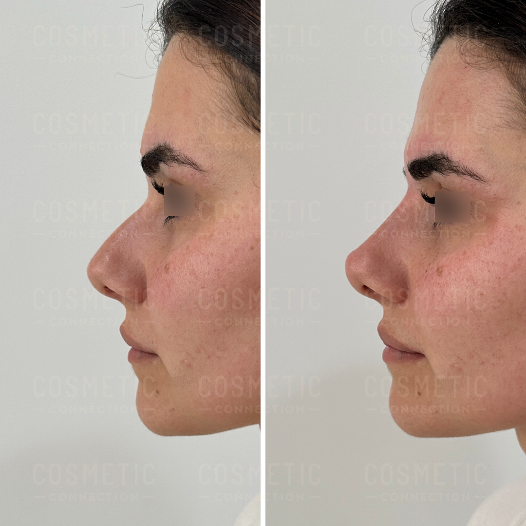 Side-by-side comparison of a persons profile before and after a cosmetic procedure. The left image shows a more pronounced nasal bridge, while the right image displays a smoother nose contour. Both images have eyes covered and text overlay present.
