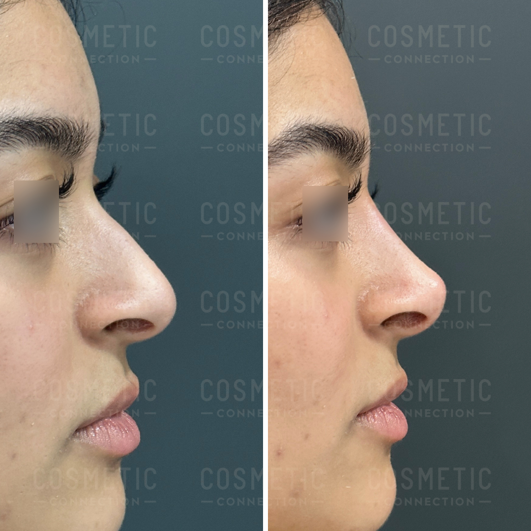 Side-by-side comparison of a persons profile before and after a cosmetic procedure. The left image shows a more pronounced nose bump, while the right image depicts a smoother nose contour. The background is gray.