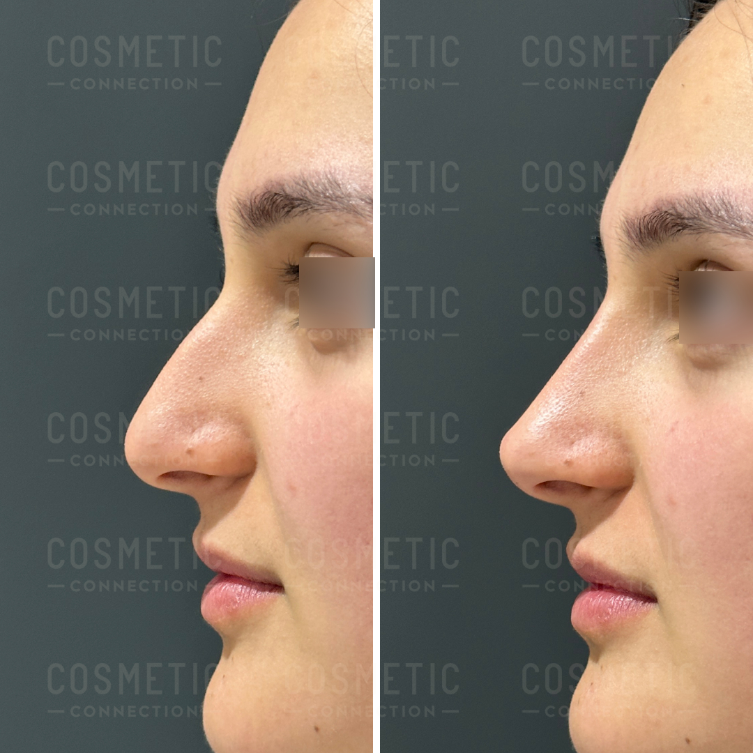 Side-by-side profile images show a persons nose before and after cosmetic surgery. The left image displays a more prominent nose with a hump, while the right image shows a smoother, streamlined contour. Both images have blurred eyes.