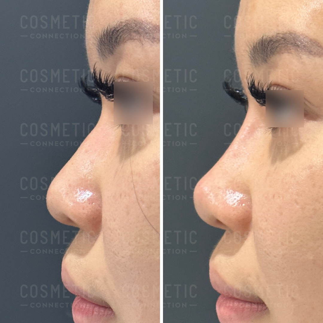 Side-by-side images of a persons nose before and after a cosmetic procedure. The left image shows a more prominent bridge, while the right image shows a smoother, refined profile. Eyes are blurred for privacy.