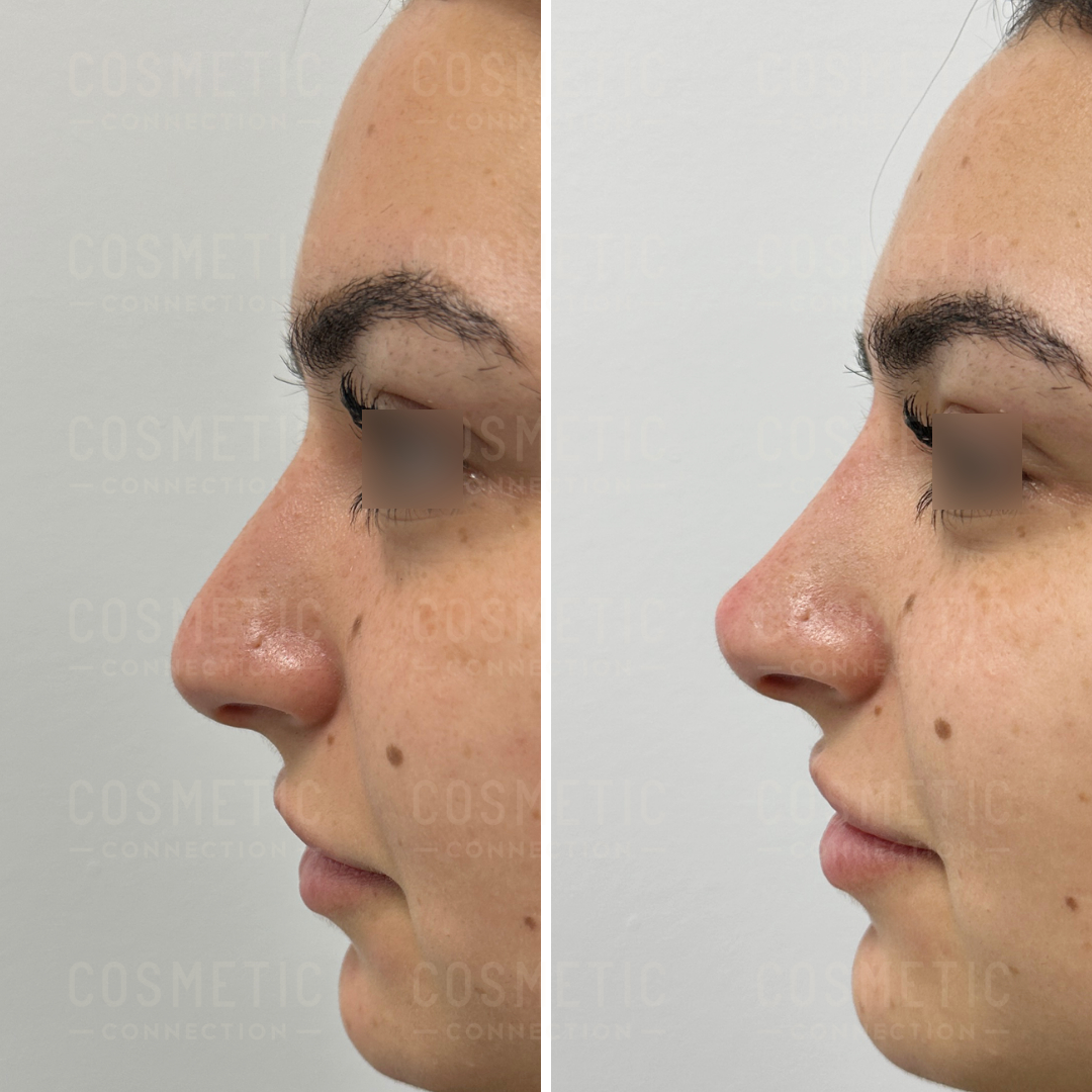 Side-by-side before and after photos comparing the profile of a persons nose. The left image shows the nose with a bump, and the right image shows the nose with a smoother profile. The persons eyes are obscured for privacy.