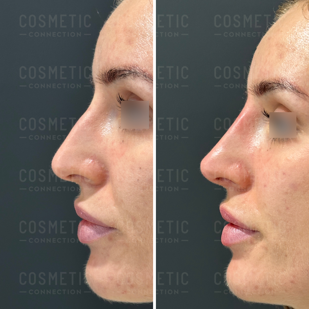 Side-by-side profile images of a womans face, showcasing a before-and-after comparison of a cosmetic procedure. The left image shows the original profile, while the right image displays a refined nose profile and smoother skin.