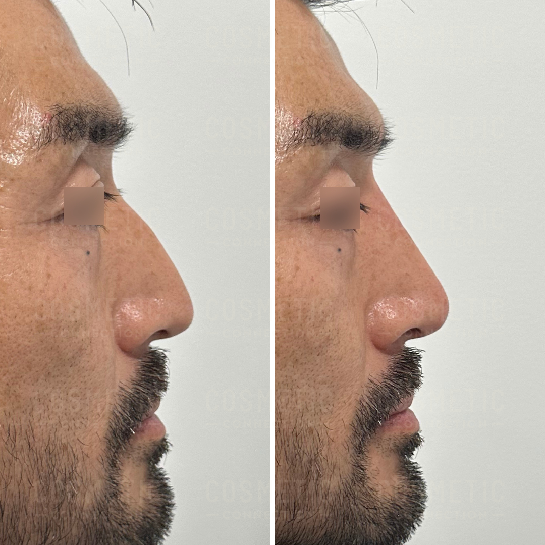 Side-by-side profile photos of a mans face showing a before and after comparison. The left image displays a slightly curved nose, while the right image shows a straighter nose. The man has facial hair and his eyes are blurred for privacy.