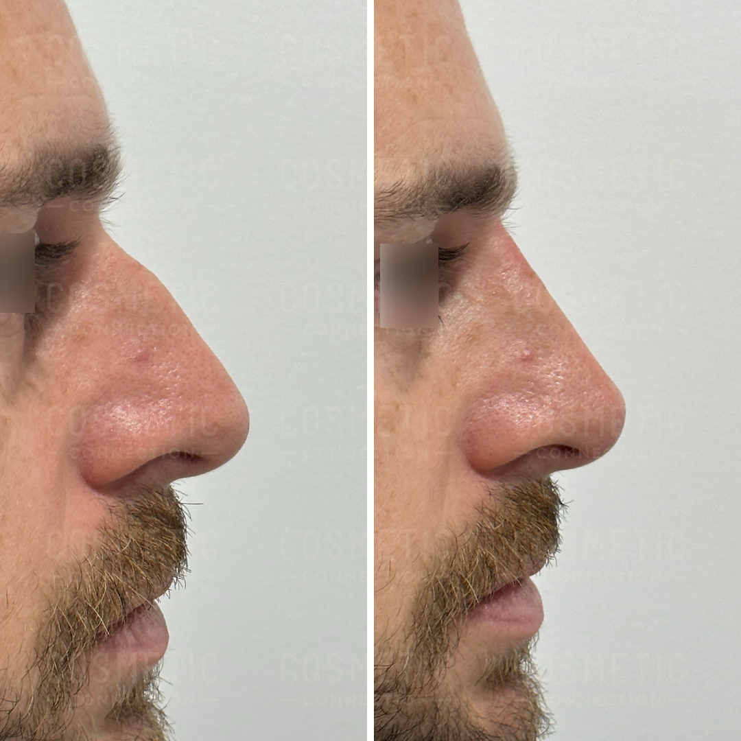 Side-by-side comparison of a mans face in profile before and after a cosmetic procedure on the nose. The images show a smoother and more refined nose shape in the after photo.