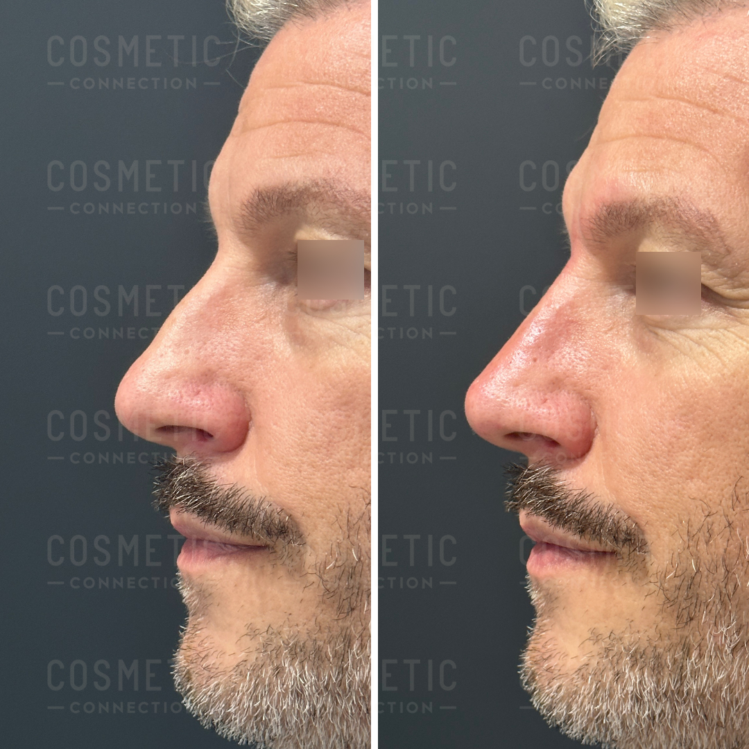 Side-by-side comparison of a mans profile before and after non-surgical rhinoplasty. The left image shows a more prominent nasal hump, while the right image shows a smoother nasal bridge. The background has the text Cosmetic Connection.