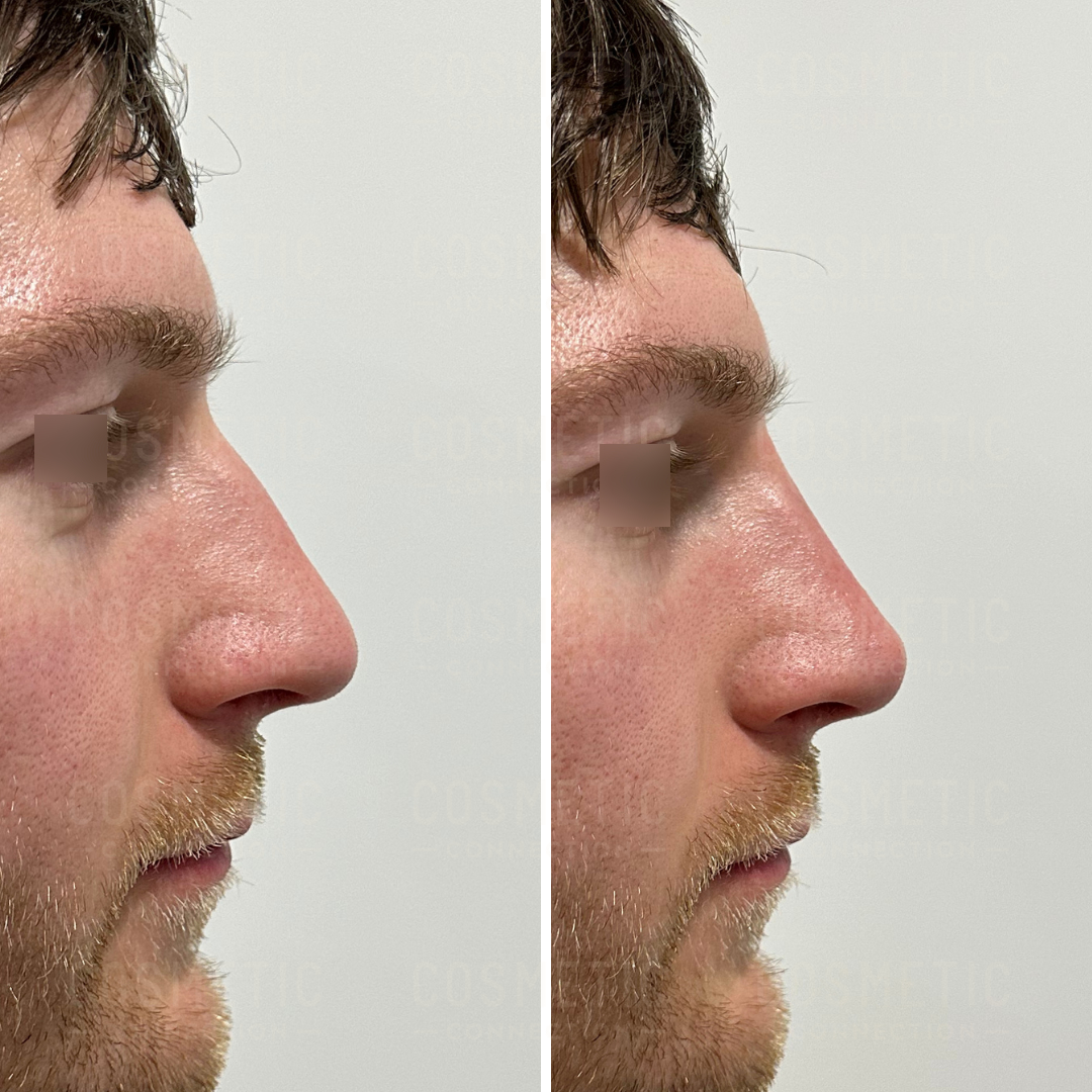 Side-by-side profile images show a persons face before and after rhinoplasty. The left image displays a more prominent nose, while the right image shows a refined nose shape.