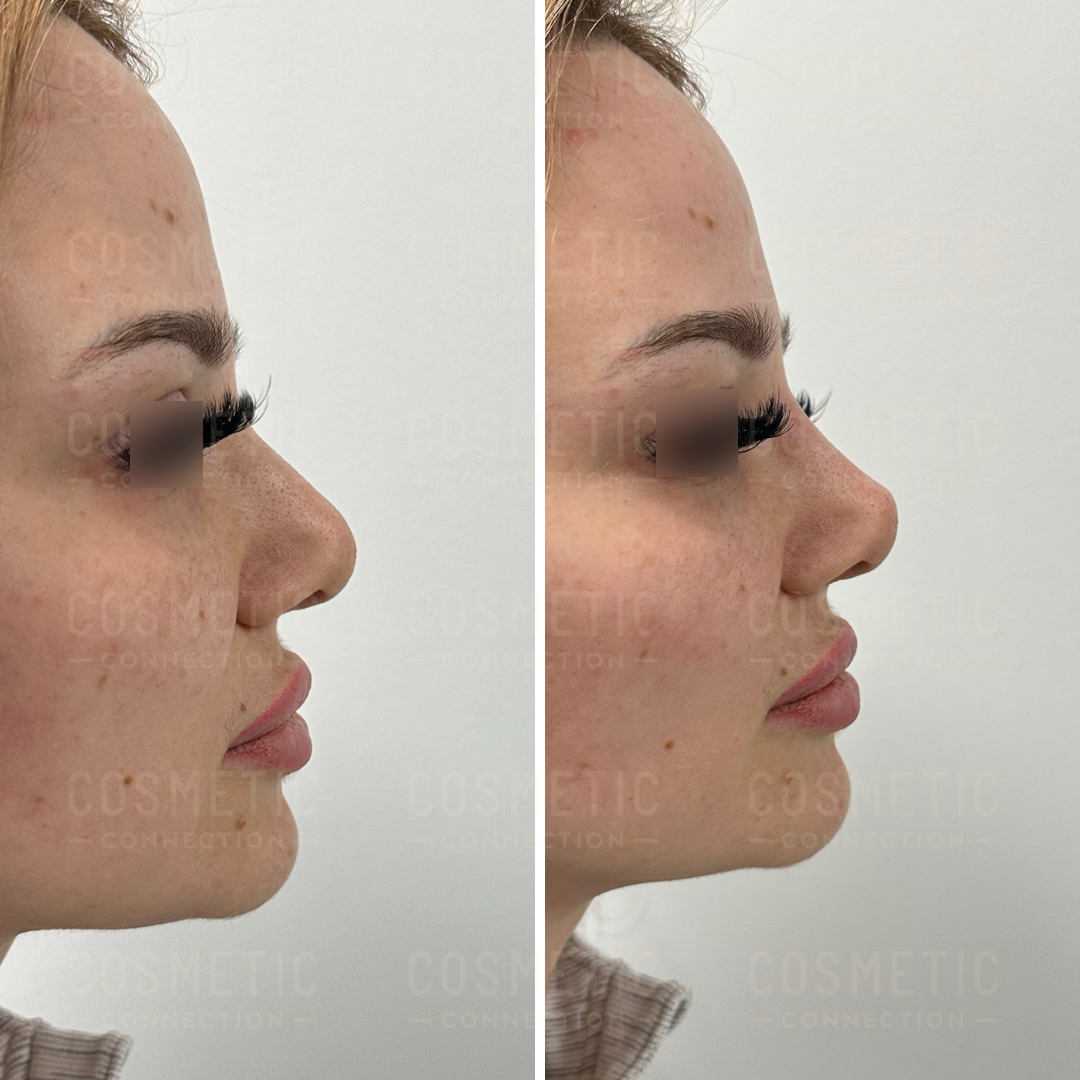 Side-by-side comparison of a womans profile showing before (left) and after (right) cosmetic nose surgery. The left image displays her original nose shape, while the right image shows a refined nose with a smoother contour.