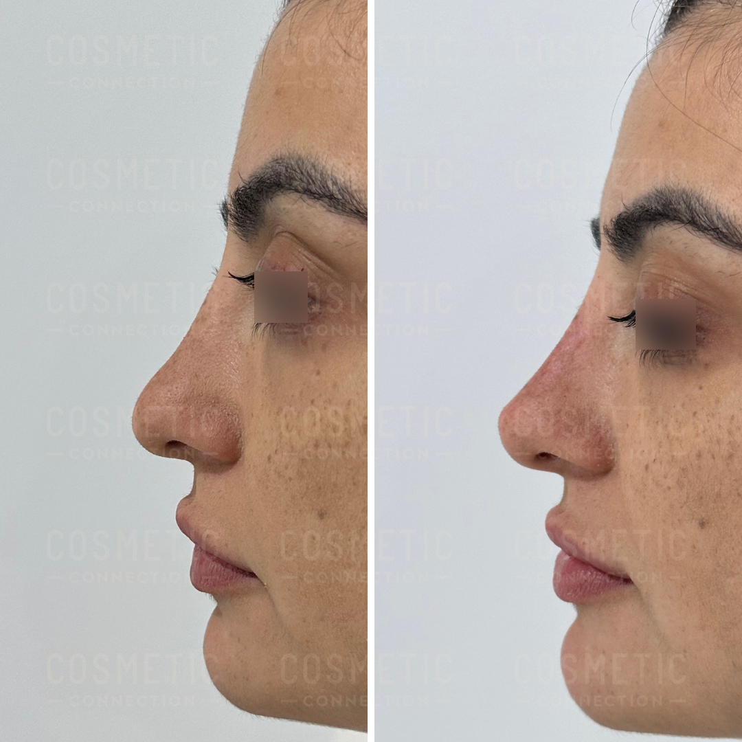 Side-by-side comparison of a womans profile before and after a cosmetic procedure. The left image shows the nose with a dorsal bump, while the right image shows a smoother nose profile. Both images have her eyes closed.