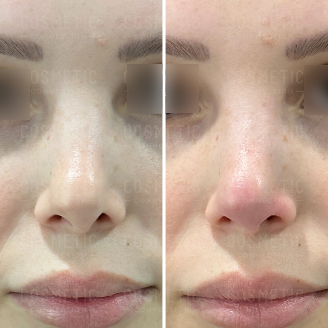 Close-up side-by-side comparison of a persons nose. Left: smooth, unblemished skin. Right: shows a slight redness on the nose tip. The photo looks like it focuses on skin condition or treatment effects.