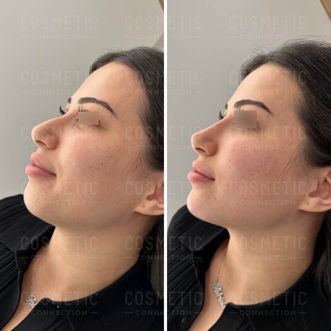 Side-by-side comparison of a womans profile before and after a cosmetic procedure. The left image shows her with natural features, while the right image shows a refined nose and smoother skin. Both images have text overlay reading COSMETIC CONNECTION.