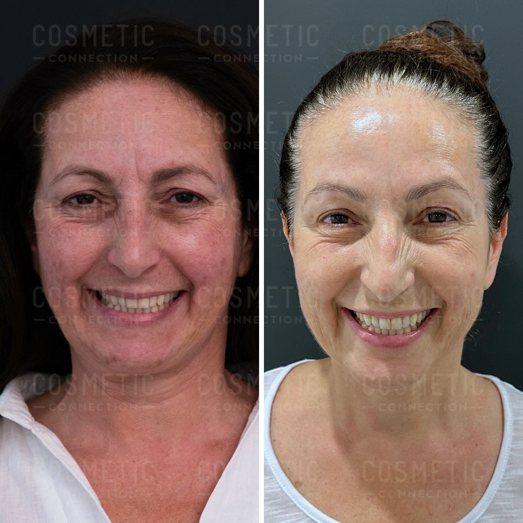 A before-and-after photo of a woman smiling. The left image shows her with a more relaxed expression and natural skin tone. The right image shows her with a brighter complexion and smoother skin, suggesting possible cosmetic changes.