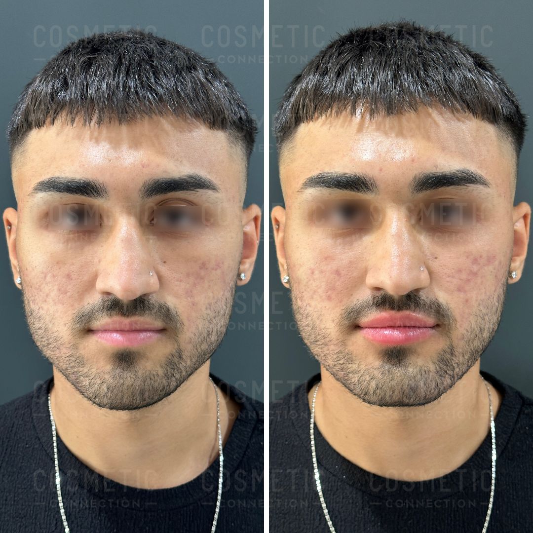 Side-by-side comparison of a man with dark hair and a goatee, showing his face before and after a cosmetic treatment. His skin appears smoother in the after image. He is wearing a black shirt and a silver necklace.