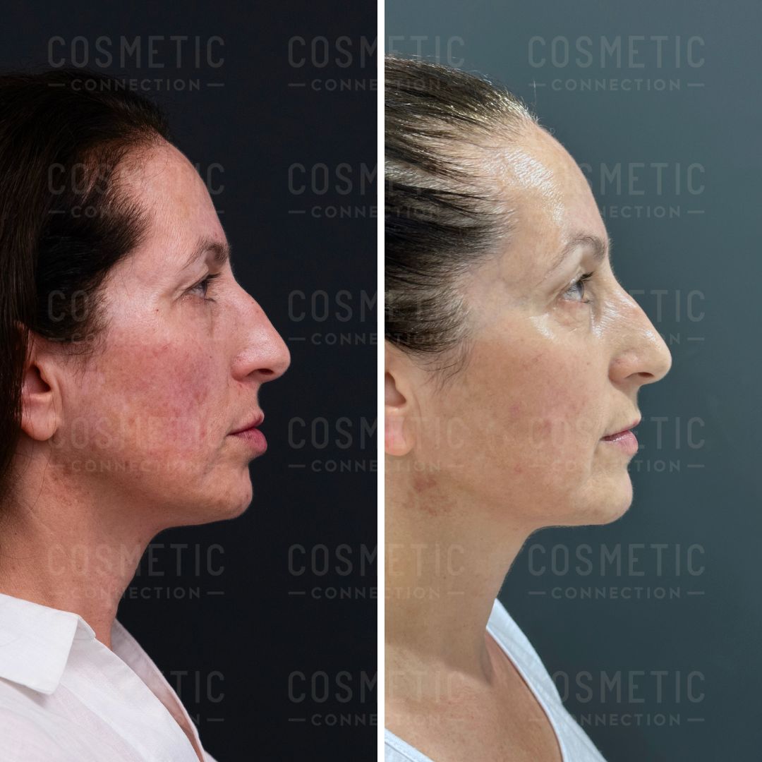 Side-by-side profile view of a woman before and after a cosmetic procedure. The left image shows her face with visible wrinkles and skin imperfections, while the right image shows a smoother skin appearance.