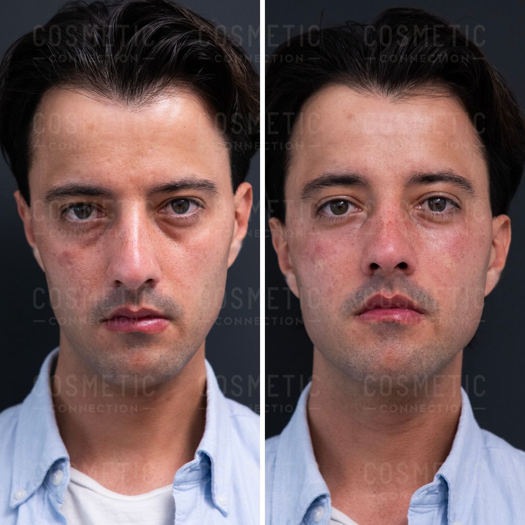 Two side-by-side images of the same man with dark hair. Left: He appears serious with mild under-eye bags. Right: His skin looks smoother and rosier, with an expression similar to the left image. Both images have a dark background.