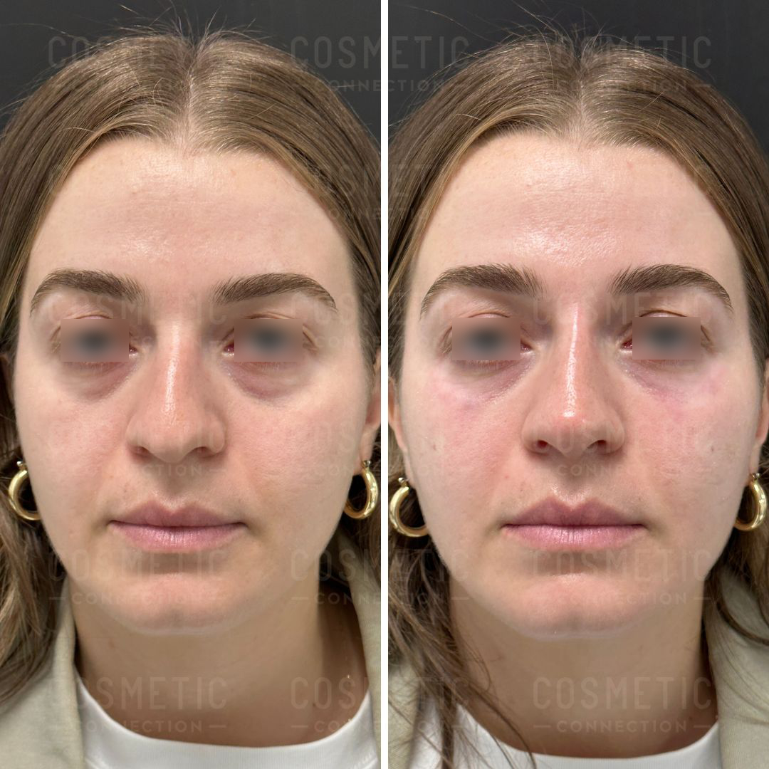 Side-by-side comparison of a woman before and after a cosmetic procedure. Both images show her with straight hair and wearing hoop earrings. The left image shows her with undereye circles, while the right shows a smoother complexion.