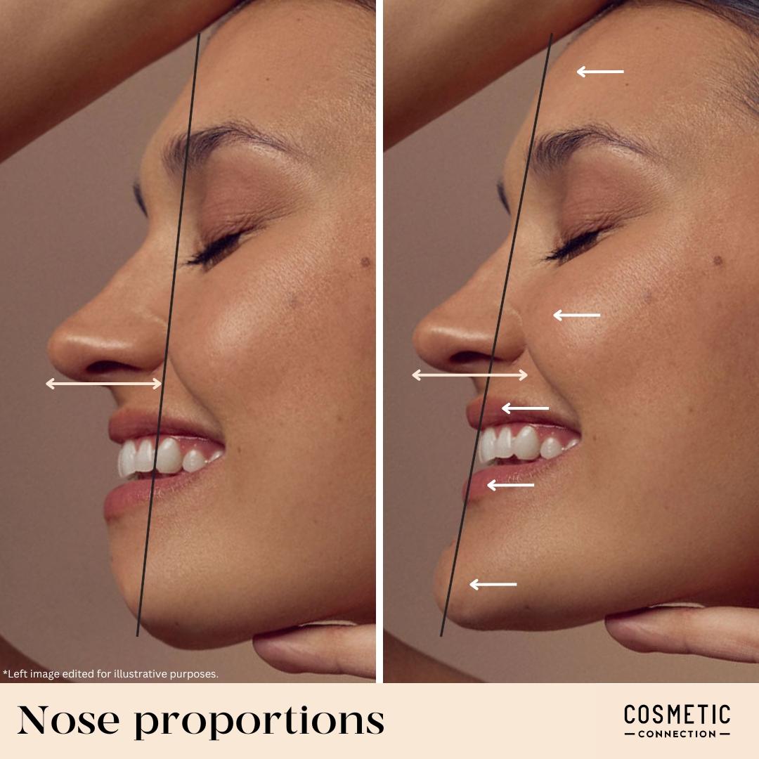 Close-up of a womans side profile, showing nose proportions. Left image has a black line highlighting the nose angle, and the right image includes white arrows pointing to the nose, lips, and chin, demonstrating ideal facial symmetry.