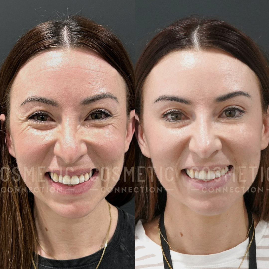 Split image showing a womans face before and after a cosmetic procedure. Left: smiling with visible forehead lines; Right: smoother skin and even complexion. Hair is straight and brown. Both photos feature similar lighting and background.