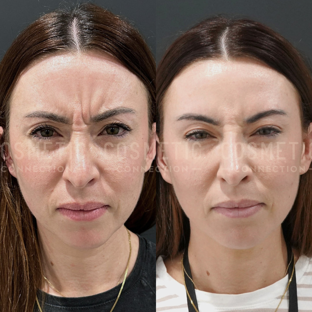 Side-by-side images of a woman with a neutral expression. The left image shows her with more pronounced forehead wrinkles. The right image appears smoother, suggesting a possible cosmetic treatment.