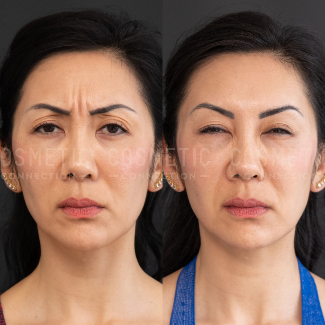 Side-by-side images of a woman showing before and after results. The left image shows her with a frown and lines between her eyebrows. The right image shows a more relaxed expression with smoother skin.