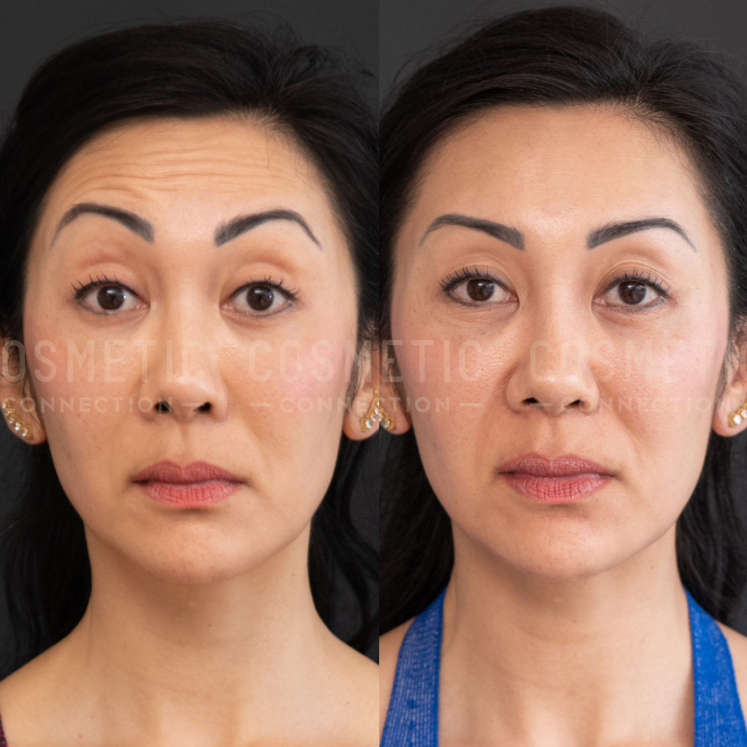 Close-up of a womans face showing a side-by-side comparison. The left image shows her with a neutral expression, while the right image shows subtle differences in skin texture and tone. She is wearing gold earrings in both images.
