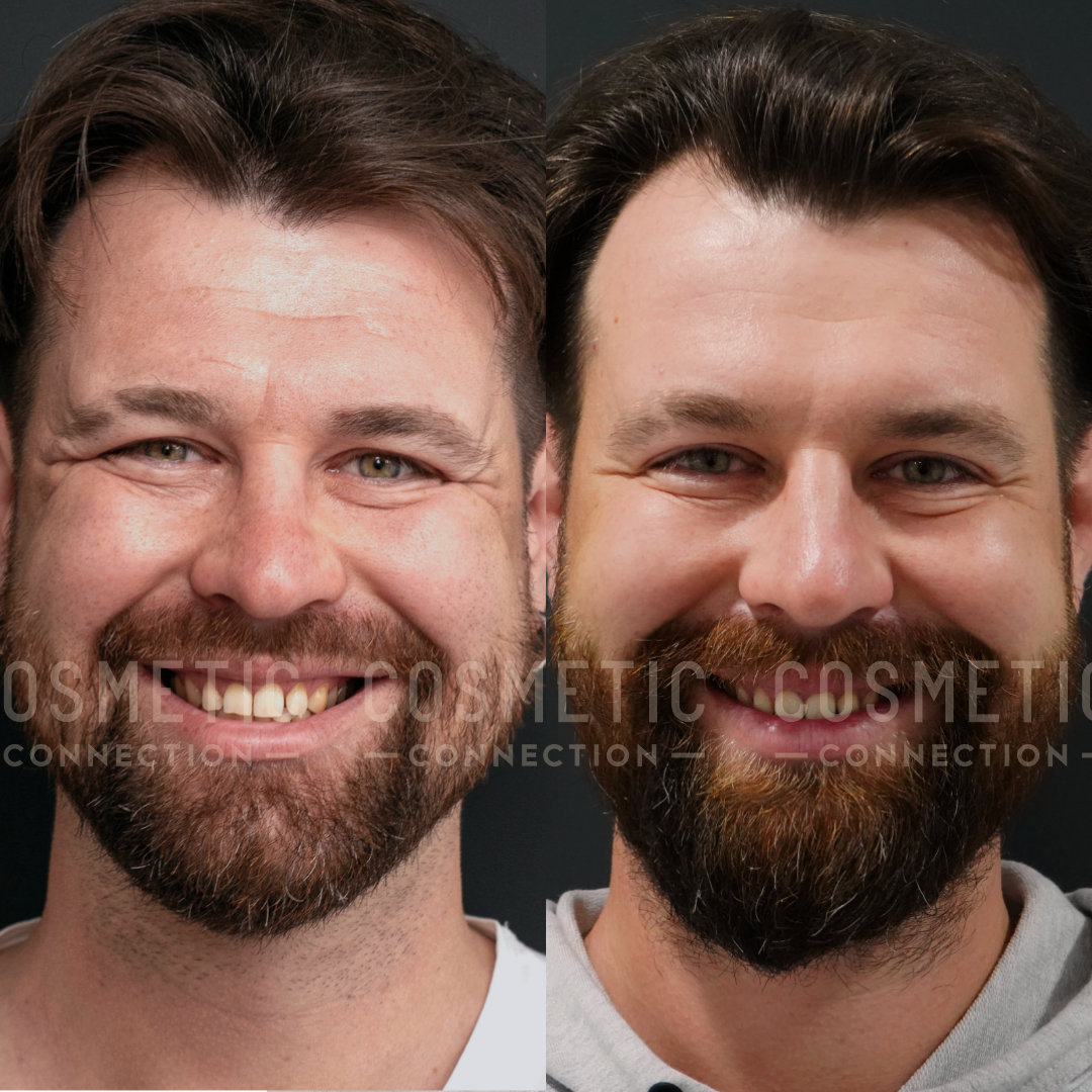 Side-by-side comparison of a mans face showing before and after cosmetic dental treatment. On the left, he has visible gaps in his teeth, while on the right, his teeth appear aligned and brighter. Both images show him smiling against a dark background.